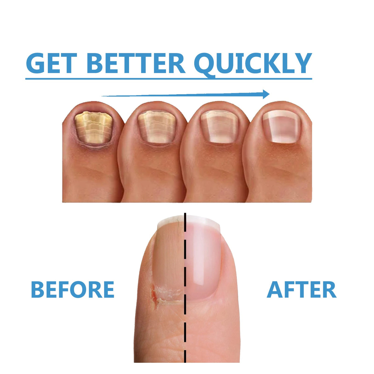 Nighttime Fungal Nail Treatment Patch, Repair Hand And Foot Inlay Rotten Nails Thickening Gray Nail Polish Care Patch